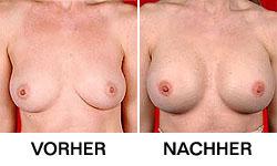 Grössere und straffere Brüste mit BreastSuccess