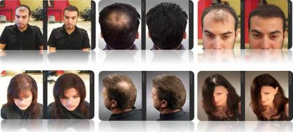 Lichtes Haar? Lichte Stellen? Dünnes Haar? Haarprobleme? Haarverlust? Haarausfal