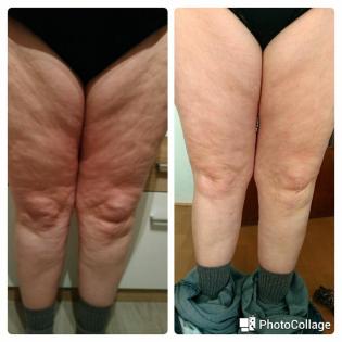 Was hilft gegen Cellulite? 