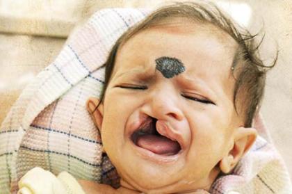 Cleft-Kinder-Hilfe durch Professor Sailer