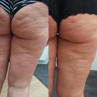 Was hilft gegen Cellulite? 