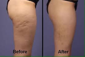 Was hilft gegen Cellulite? 