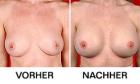 Grössere und straffere Brüste mit BreastSuccess