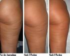 CELLULITE? SCHLAFFE HAUT?