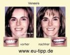 ZAHN-Behandlung CZ - Implantate ab € 490