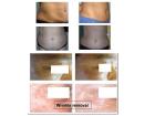 Fett- + Cellulite- + Falten- Entfernung